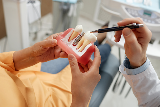 Top 5 Advantages of Using Dental Implant Service